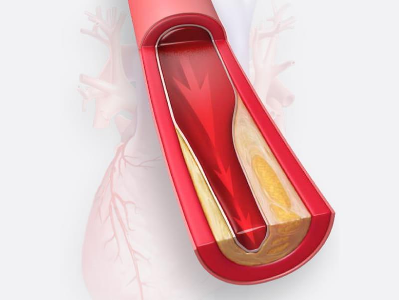 Image of artery narrowed with cholesterol. (Scott Bodell for American Heart Association)